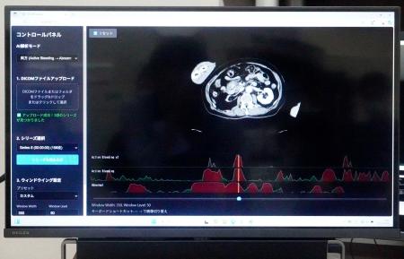 ＡＩがＣＴ画像を解析するシステム「ＥＲＡＴＳ」の画面