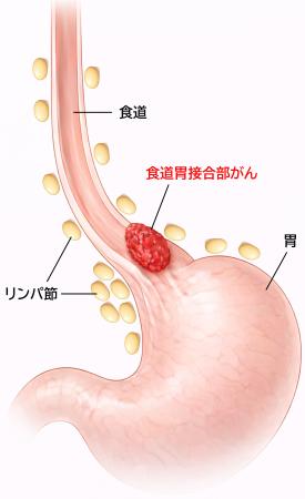 　食道胃接合部がんのイメージ図（大阪大の黒川幸典准教授提供）