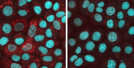 細胞内にタンパク質「ＴＤＰ４３」の凝集体（赤色）が蓄積している状態（左）と、細胞に化合物を入れて凝集体の形成を抑えた様子（奈良県立医大、モルミル提供）