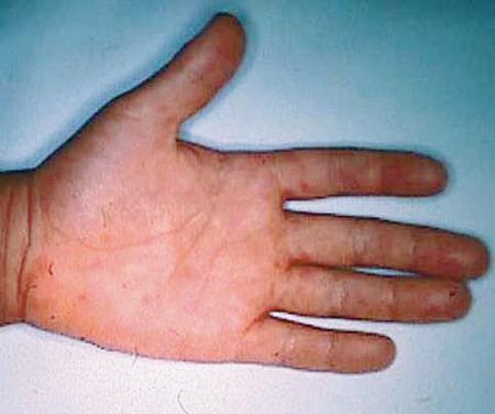 水疱性発疹ができた手足口病患者の手（国立感染症研究所、現・国立健康危機管理研究機構提供）